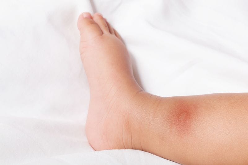 What You Need to Know About Ross River Virus What You Need to Know About Ross River Virus
